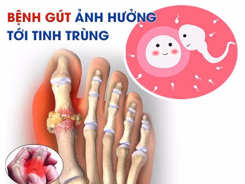 [Giải đáp] Bệnh gút có ảnh hưởng đến tinh trùng không?